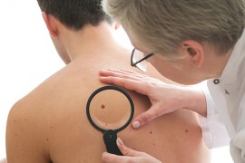 Wenn fehlender Sonnenschutz Hautkrebs verursacht Mediziner untersucht Leberfleck eines Mannes